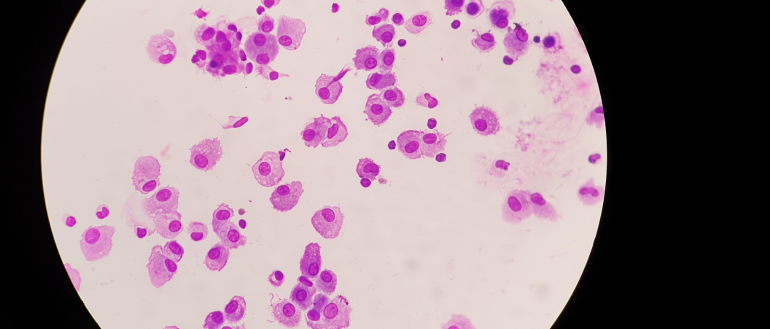 CRE-CLIMB - Childhood Lung Disease: Early-life Infection and Mechanistic Pathways to Bronchiectasis