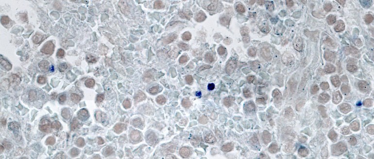 Characterisation of the hidden splenic burden of malaria in Africa