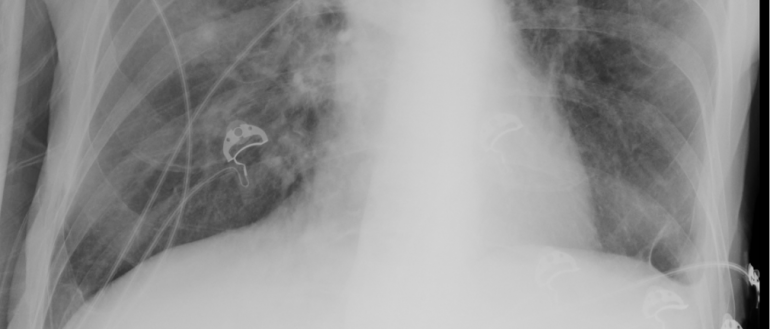 Tuberculosis rates fall in the Top End