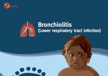 Bronchiolitis (lower respiratory tract infection)